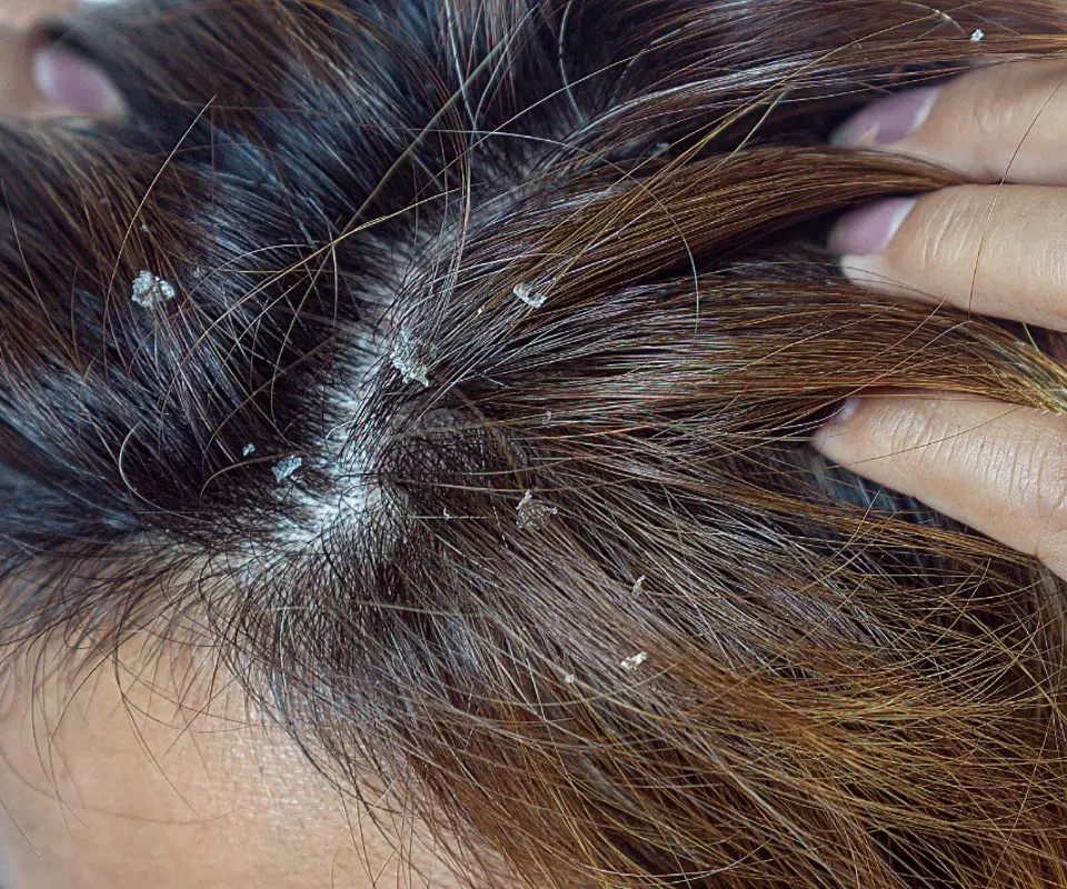 Scalp care for dandruff problems